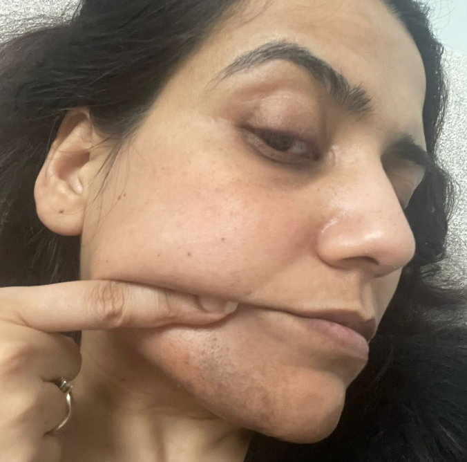 Hyperpgmentation Month hyperpigmentation - uncouth